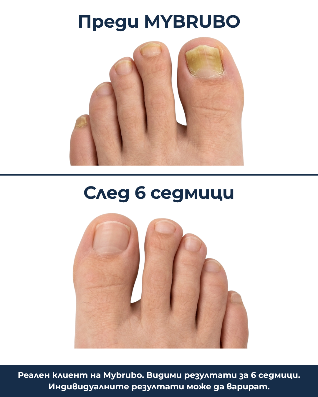 Лепенки за гъбички по ноктите BRUBO